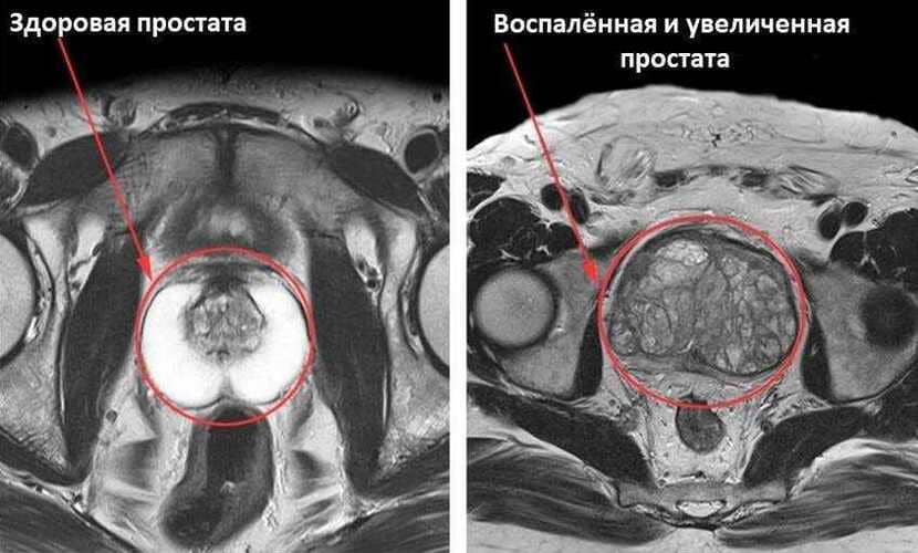 МРТ предстательной железы