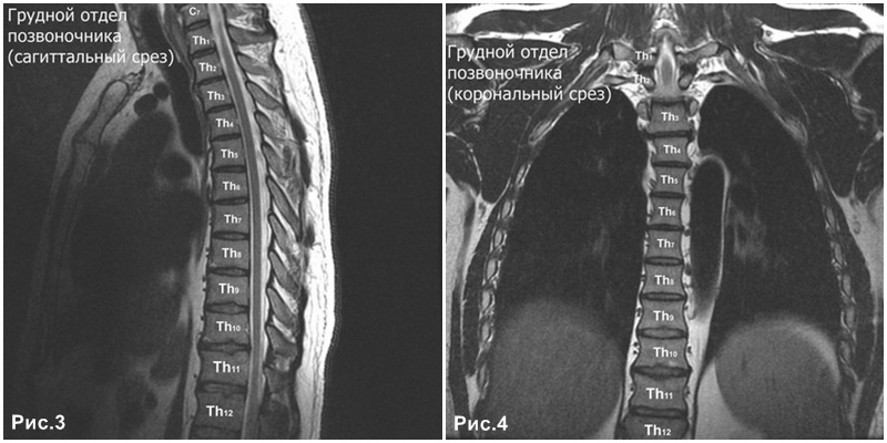 МРТ грудного отдела позвоночника