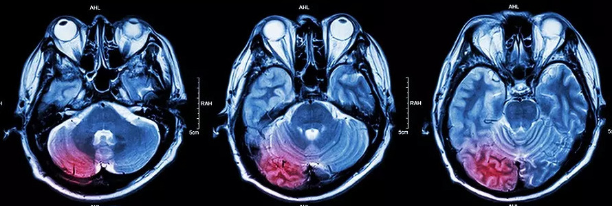МРТ головы с контрастом