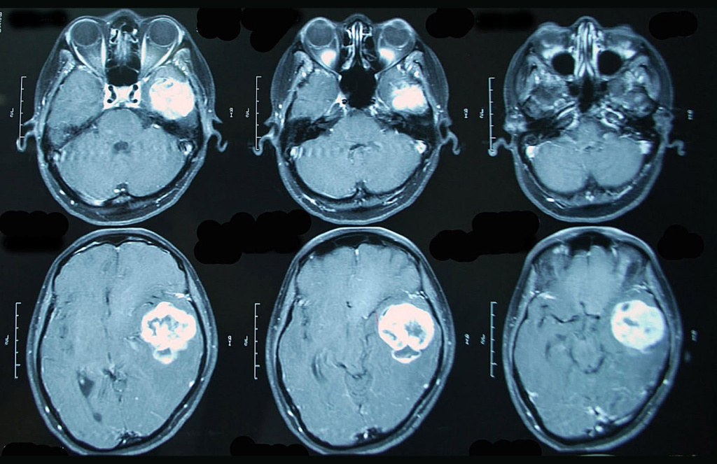 Примеры выявления рака в головном мозге с помощью МРТ