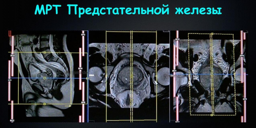 МРТ предстательной железы с контрастом